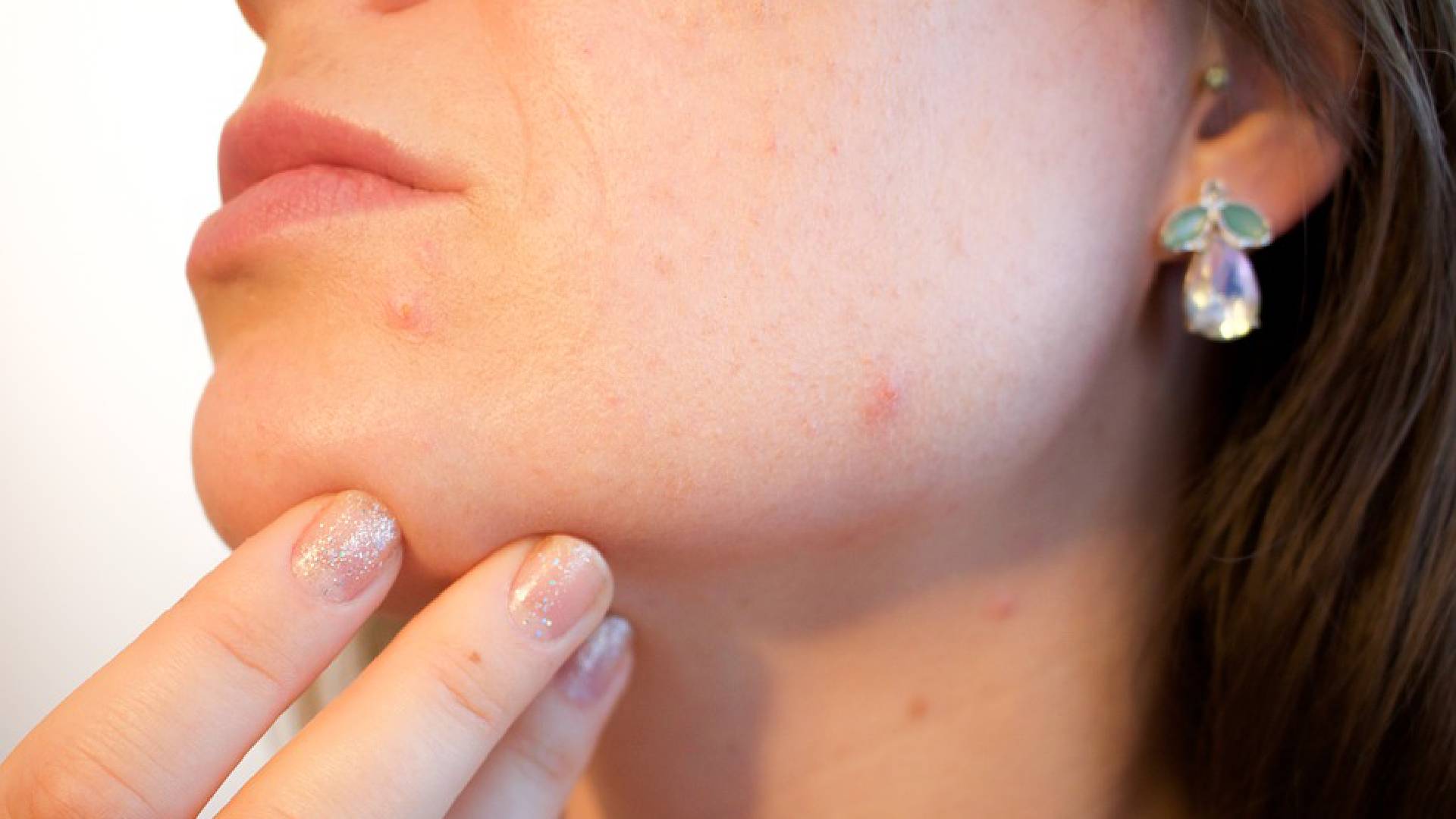 Skin Care Tips: चेहरे के दाग-धब्बों से हैं परेशान, तो इन घरेलू उपायों से रातों-रात हटाएं फेस के निशान