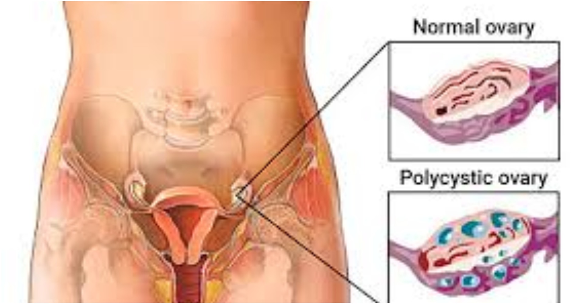 PCOS/PCOD: पॉलीसिस्टिक ओवरी सिंड्रोम होने के बावजूद भी आप बन सकती है माँ, फॉलो करना होगा ये टिप्स