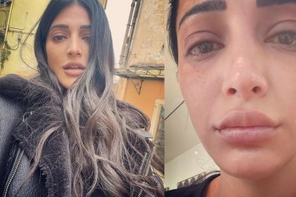 Shruti Haasan shared pictures of swollen face and disheveled hair