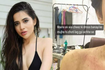 Urfi Javed get bruised shows wound after wearing green net dress